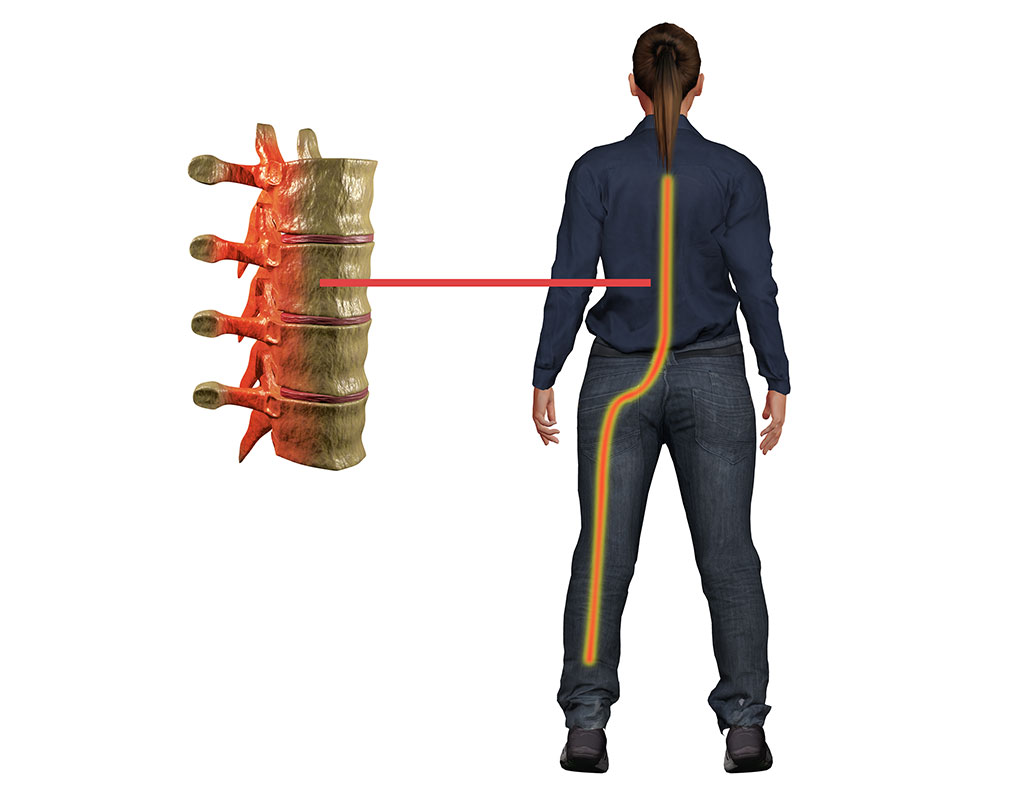 sciatalgia